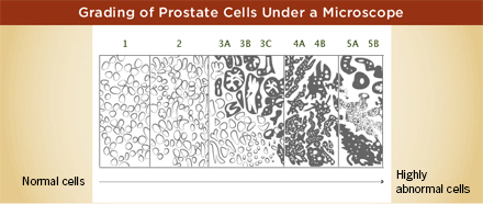 Grading of prostate cells under a Microscope